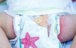 Опрелости у новорожденных – симптомы, лечение и профилактика Как выглядит опрелость у детей